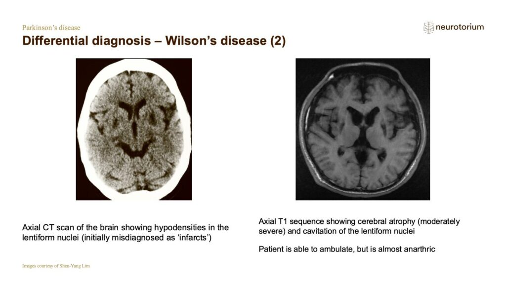 Differential diagnosis – Wilson’s disease (2)